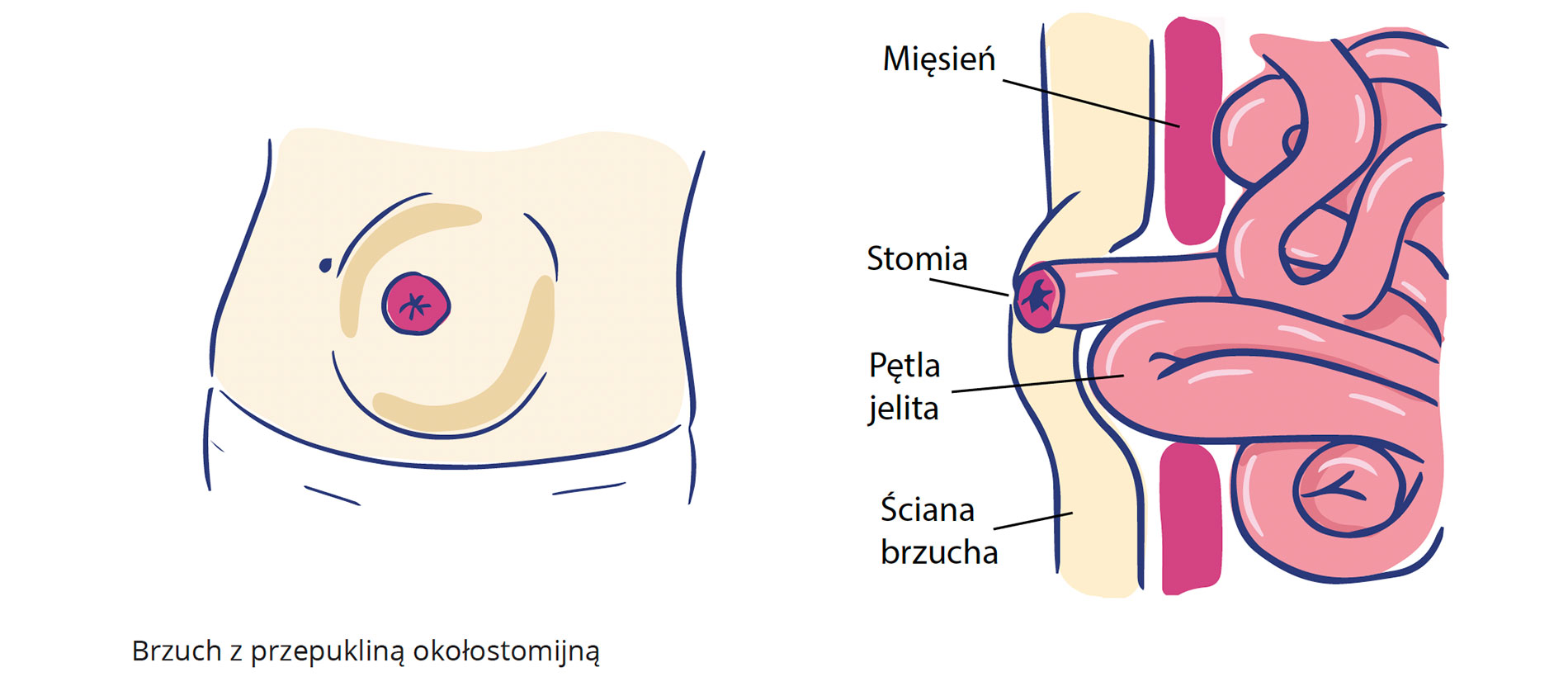 przepuklina-okolostomijna-naglowek.jpg