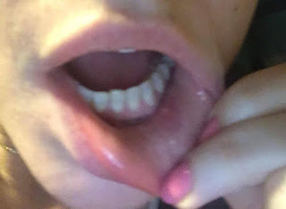 Post Pauliny Poszkodowane usta.jpg