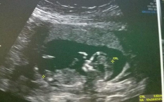 Roksana Mikołajczak: Pierwsze badania prenatalne