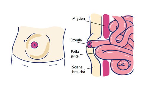 Przepuklina okołostomijna